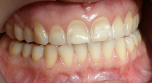 Erosione Dentale