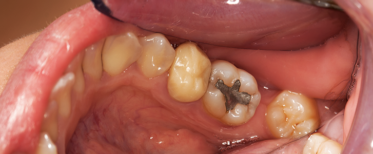rottura di un molare