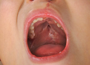 larghezza del palato ortodonzia bologna