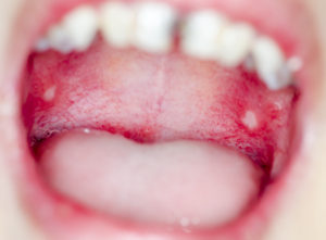 allergia bocca